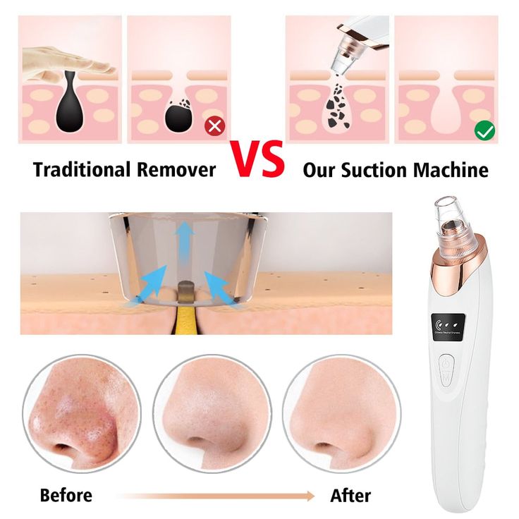 Blackhead Remover Exfoliating Beauty Device - Pakisma